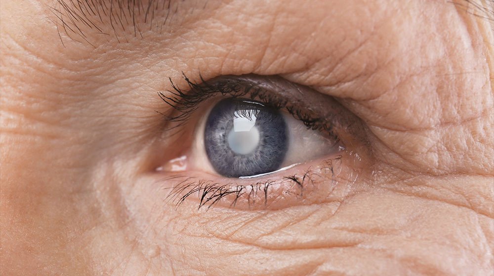Senior-woman-face-with-wrinkles-what is the first sign of glaucoma_-feat