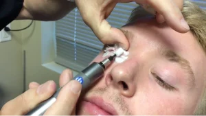 BlephEx dry eye treatment