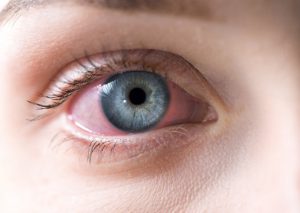 pink eye image