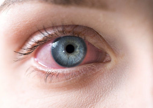 pink eye image