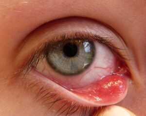 What is a Chalazion