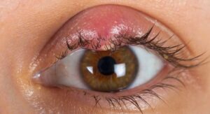 How to Treat and Prevent Eye Styes